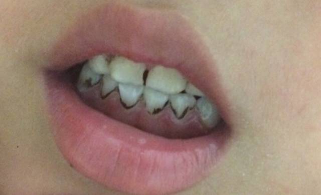 一般的刷牙方法能清除牙菌斑,小朋友牙齿有牙菌斑要洗掉吗