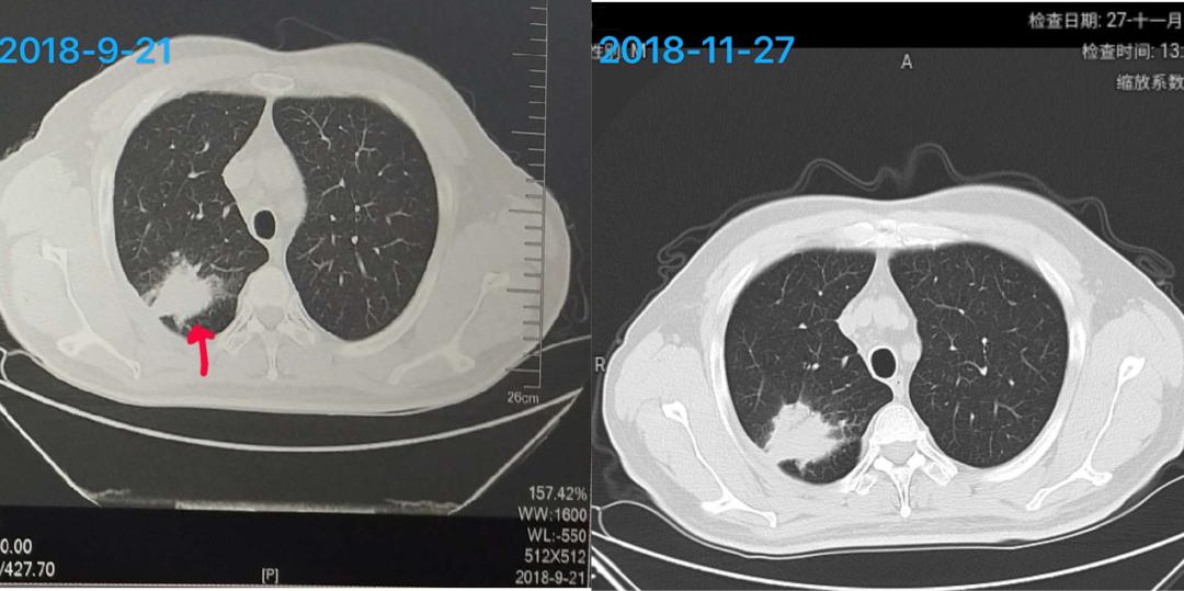 pd-1免疫治疗治愈案例,pd-1免疫治疗有效率是指什么