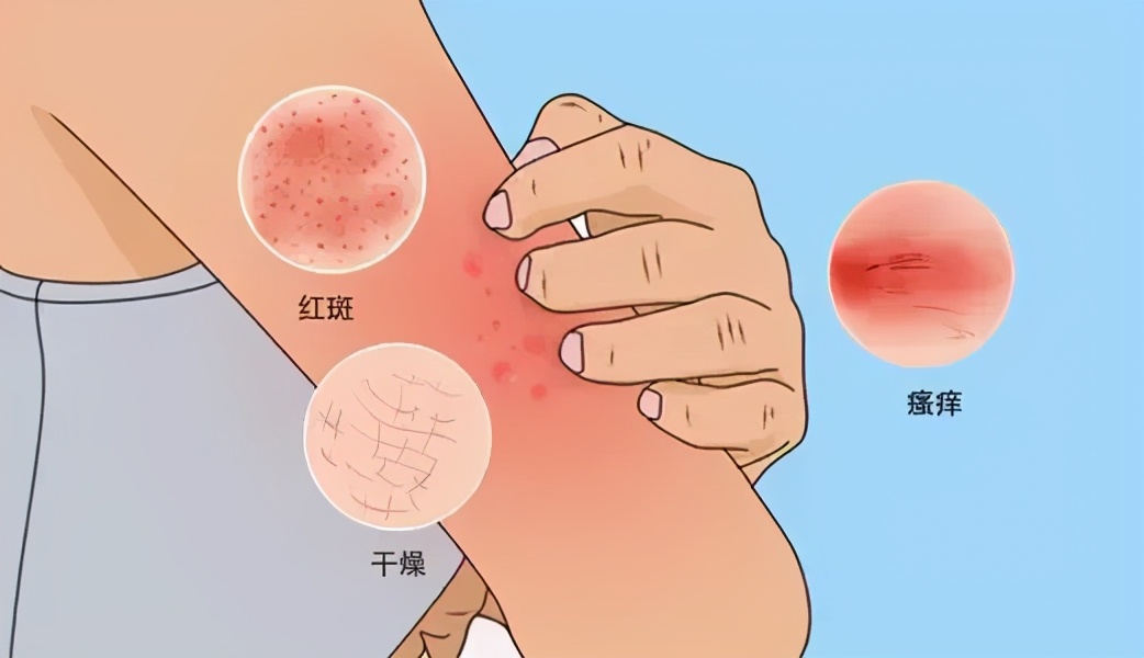 有湿疹不得癌症吗,湿疹不容易得癌症