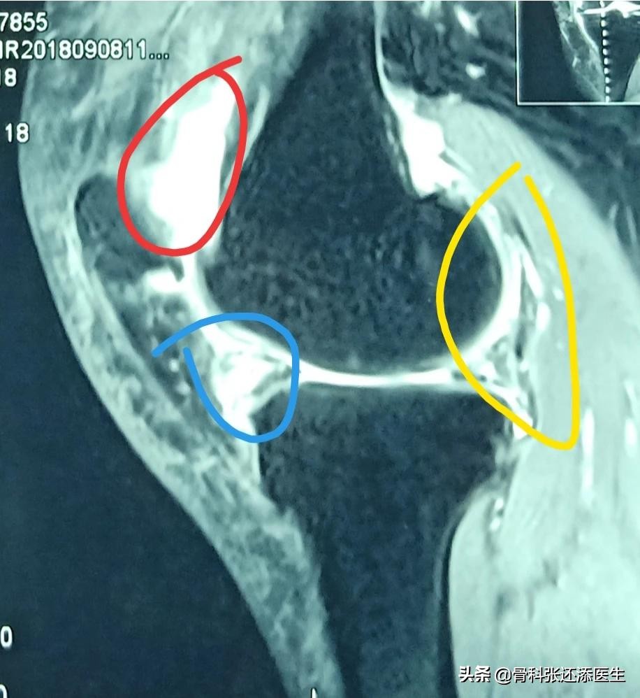 花椒治疗滑膜积液,艾叶生姜花椒敷膝关节积液管用吗