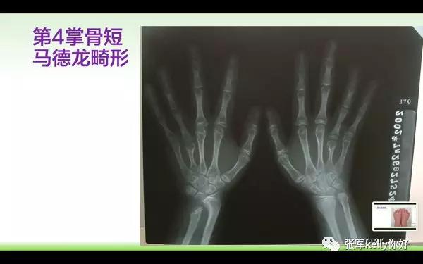 Turner综合征的指南学习