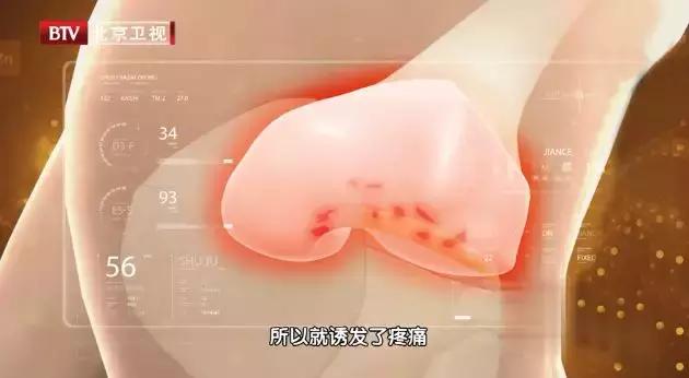 抽关节积液有什么危害,关节积液到底抽还是不抽