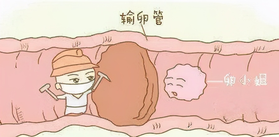 单侧输卵管会造成宫外孕吗,输卵管堵塞可以吃中药调理吗