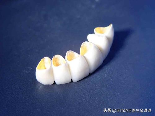 明星全口烤瓷牙的危害,明星为什么都做烤瓷牙