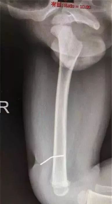 家中这些“杀手”一定要注意!2岁男孩腿上出现一凹陷的大洞