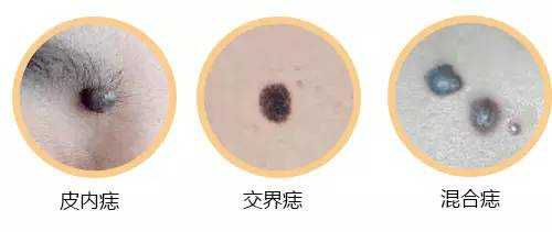 中医点痣治疗法,神奇中医点痣