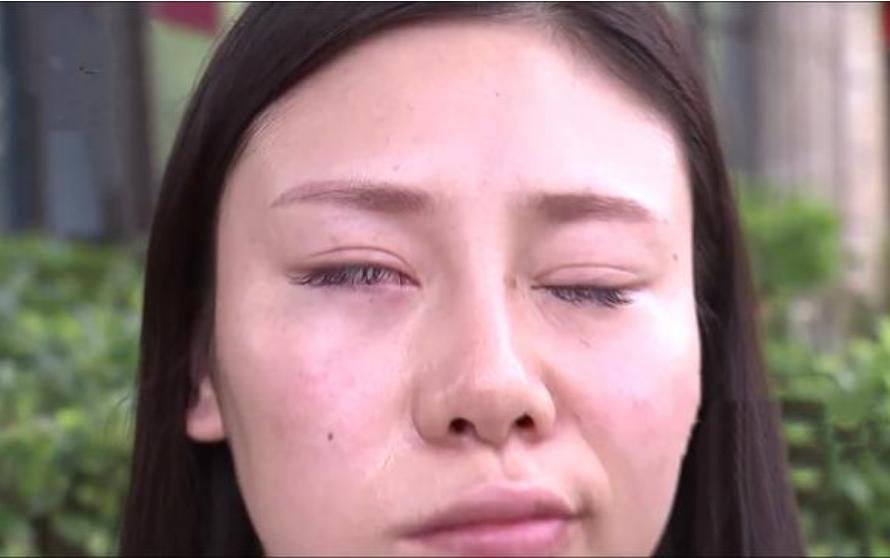 打完瘦脸嘴张开歪了,打完瘦脸针嘴歪了