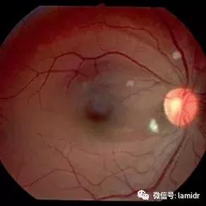 hiv感染症状及表现会口干吗,hiv的症状有眼睛红吗