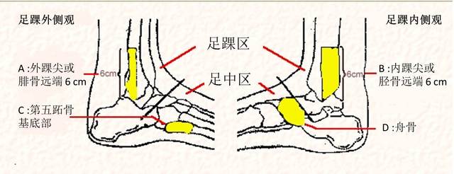 踝关节扭伤后应怎样处理,踝关节扭伤的正确处理方法500字