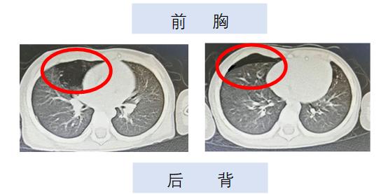 剧烈咳嗽呼吸困难上不来气,咳嗽多痰呼吸困难有哮鸣音