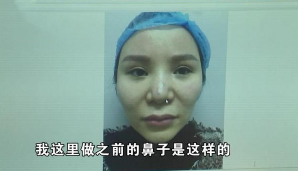 打个喷嚏鼻子假体掉出来了,打了个喷嚏堵在鼻子里了