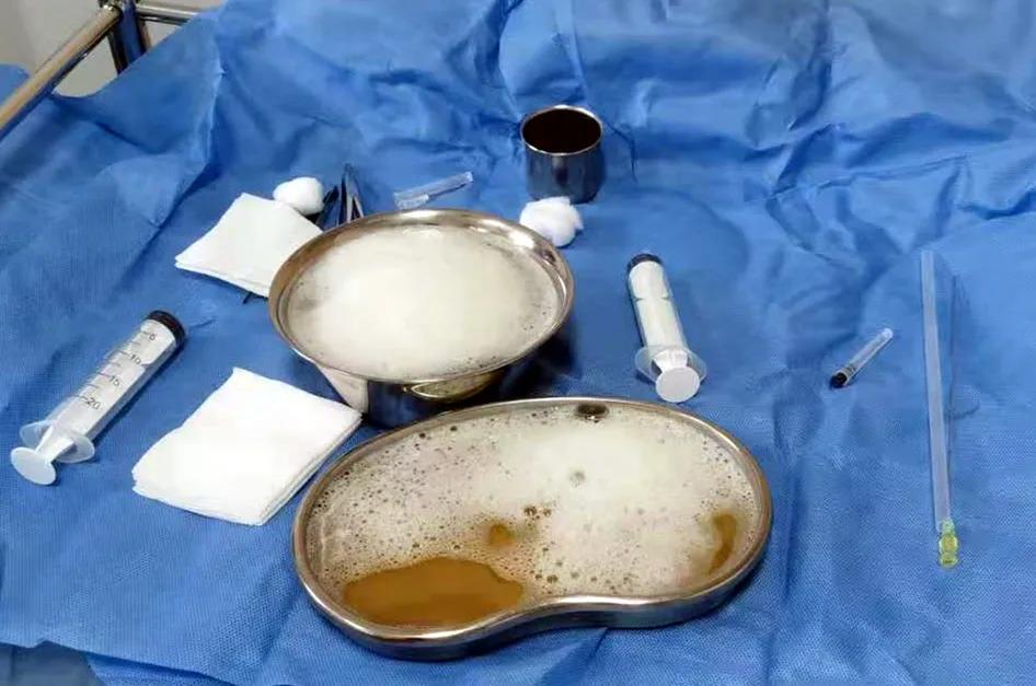 巨大肝囊肿怎么办,肝囊肿大了怎样做微创术