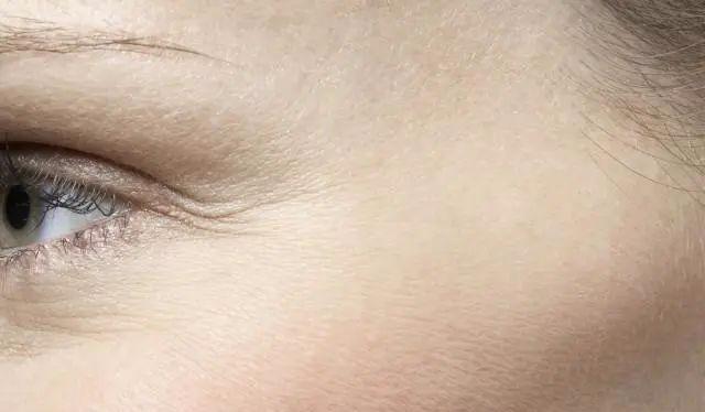 去鱼尾纹最简单的方法是哪种,鱼尾纹如何通过医美去除