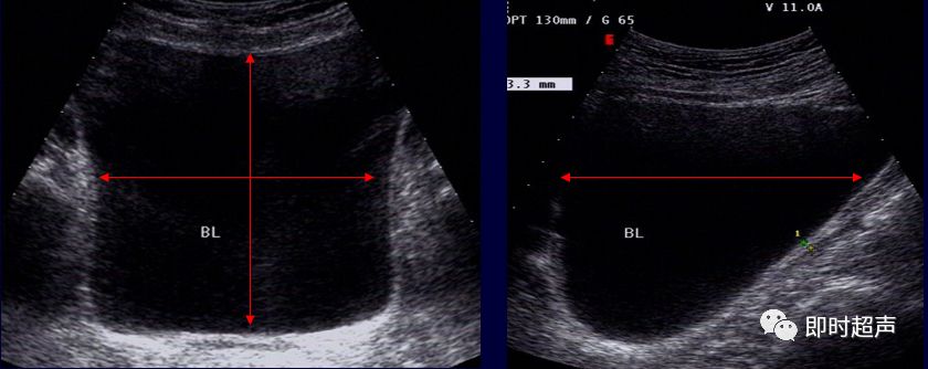 膀胱超声图解大全,膀胱超声解剖及常见病变超声表现