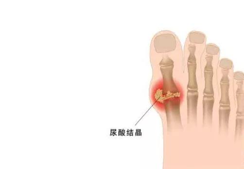 痛风的非药物处方,痛风治疗的最神秘草药