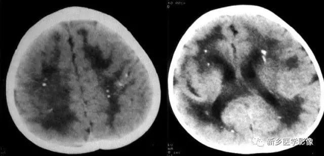颅内有钙化怎么治疗,34岁脑部有钙化正常吗