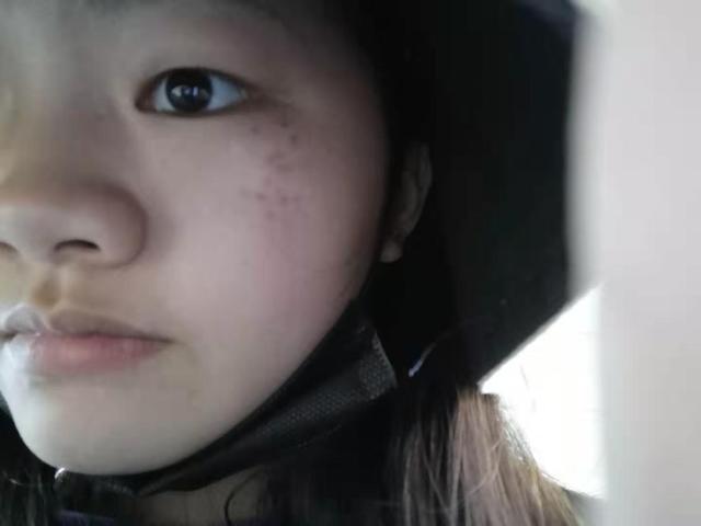 点痣点斑半年心路历程分享,点痣点斑膏真的有效果吗