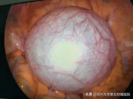 妇产科完成一例经脐单孔腹腔镜下巨大盆腔包块切除术