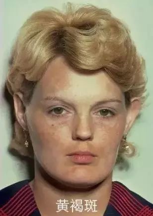 祛斑要注意哪些事项,祛斑为什么会越祛越多