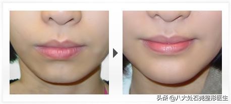 广东中医院自体脂肪填充后缩下巴,下巴自体脂肪填充需要多久