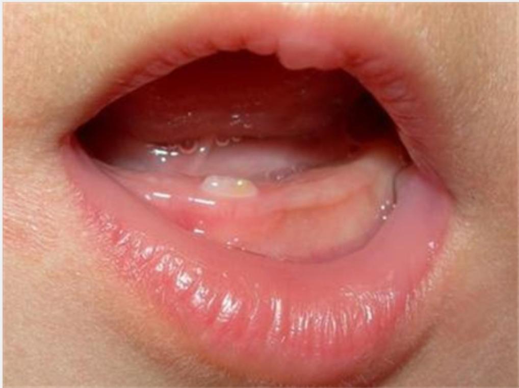 婴儿出牙顺序不正确是什么原因,你家宝宝长牙顺序图