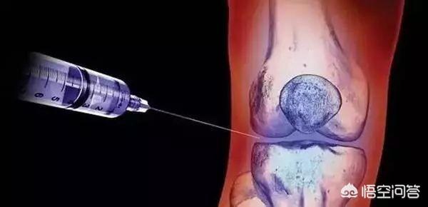 关节炎辟谣,膝关节滑膜炎辟谣