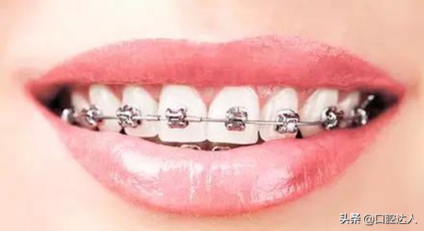 陶瓷半隐形牙套的优缺点,透明托槽和隐形牙套的区别