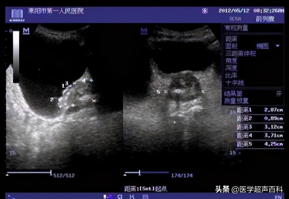 膀胱最常见肿瘤,膀胱肿瘤最常见最早的症状