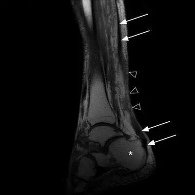 运动医学分析运动损伤案例,运动医学跟腱撕裂