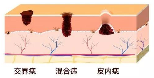 黑痣和黑痣区别图片,黑痣与一般痣癌变的概率