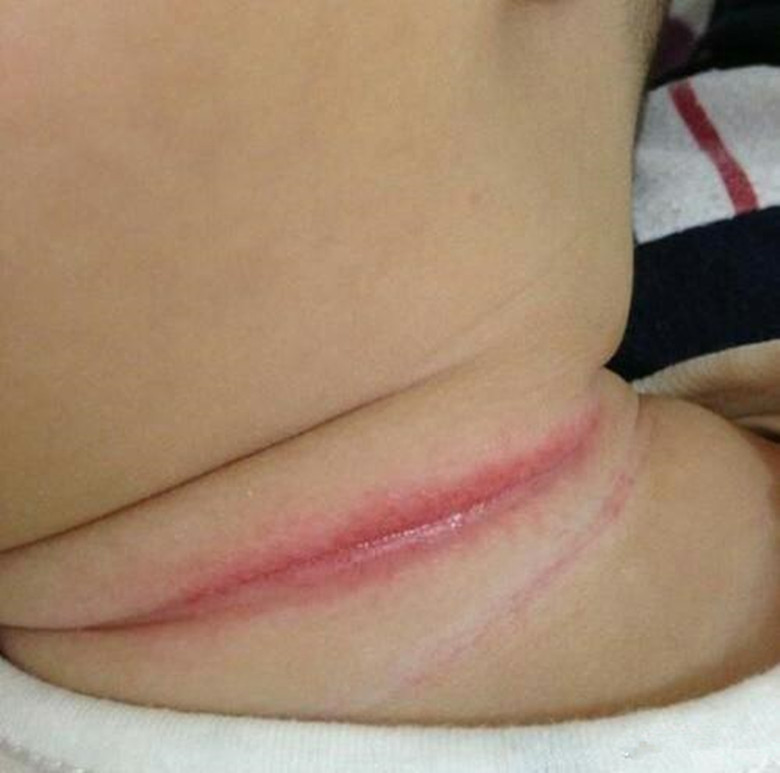新生儿淹脖子发红怎么处理,宝宝淹脖子发红起疹子怎么办