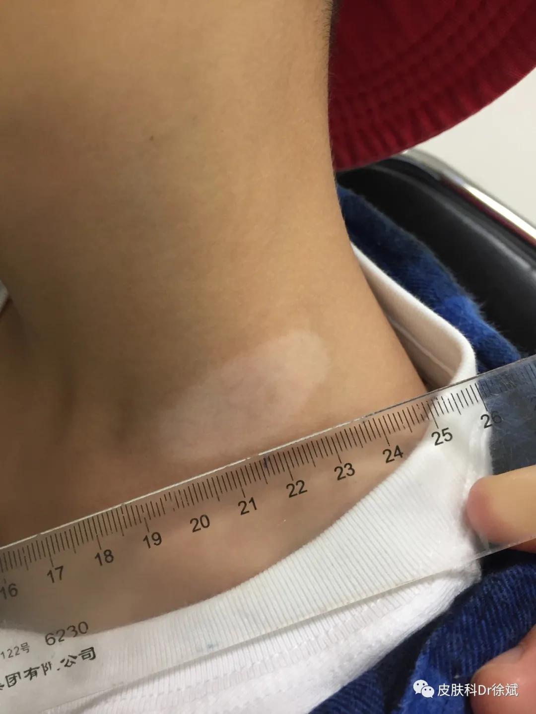 儿童治疗白癜风需要多少钱,uvb治疗白癜风多久见效