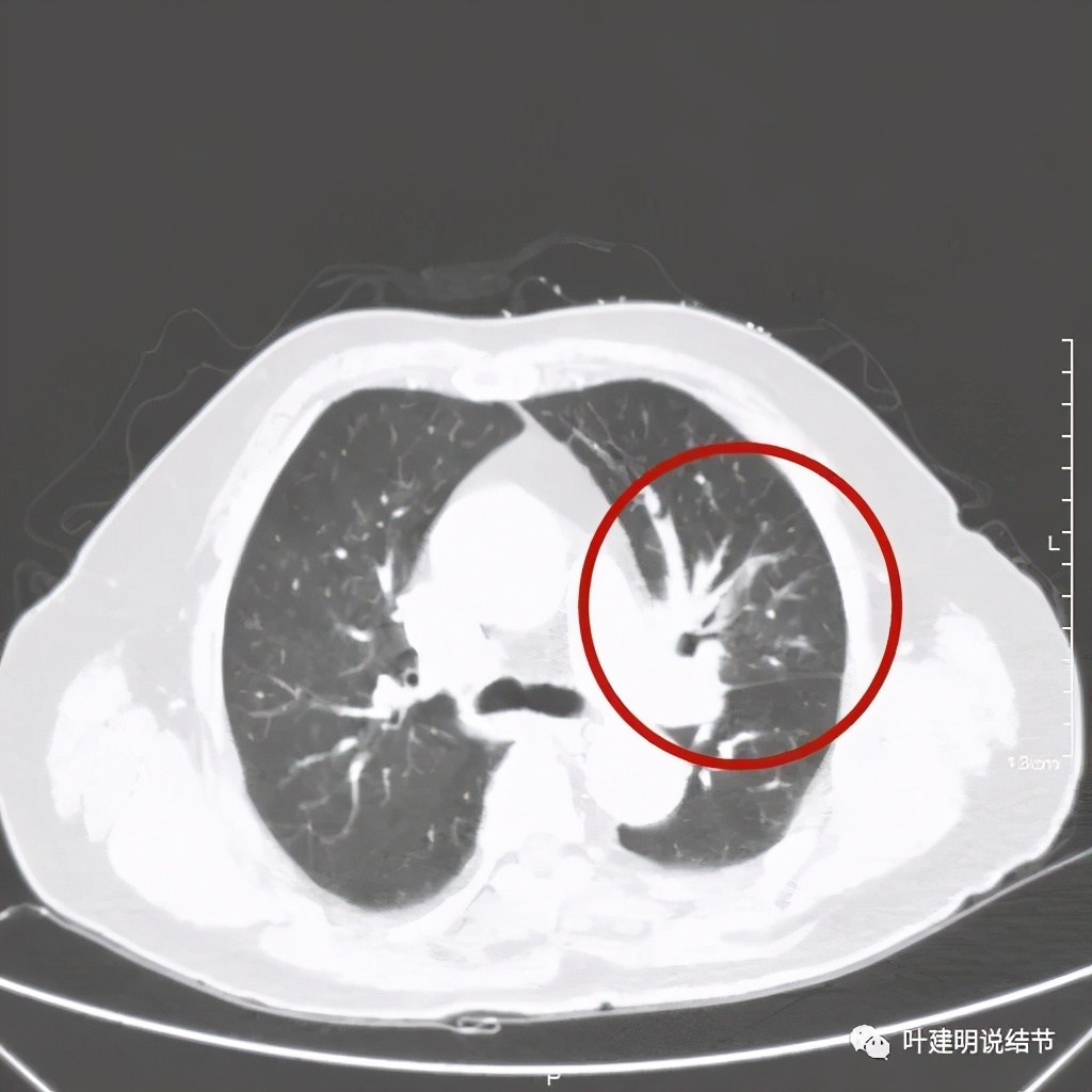 卡瑞利珠单抗治疗肺鳞癌有用吗,特瑞普利单抗对鳞癌治疗有效吗