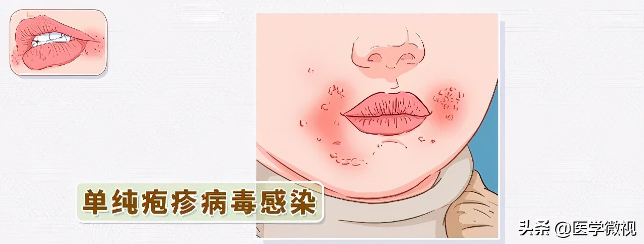 得了嘴角炎怎么办,经常烂嘴角吃什么药好得快