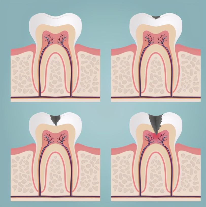 蛀牙修复之后要注意什么,蛀牙了在家里就能解决的办法