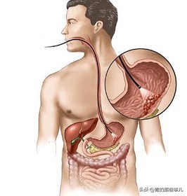 咽喉炎前期癌变症状可以治好吗,一年几次咽喉炎要警惕