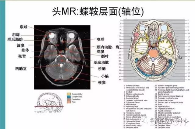 电子版头颅ct与mri断层解剖,头颅mri血管解剖与分段详解
