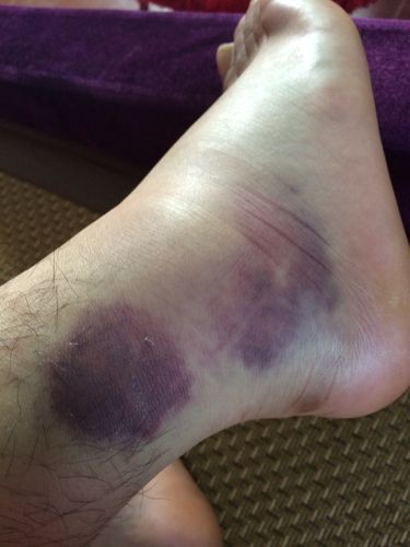 踝关节扭伤打绷带的图片,踝关节扭伤消肿治疗方法