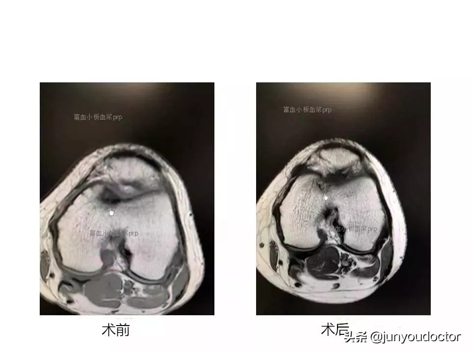 我(PRP)的超能力是富予人体超强自愈力