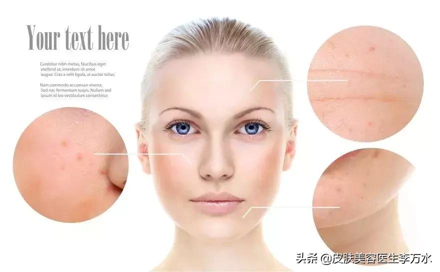 激光治疗草莓鼻,激光换肤草莓鼻