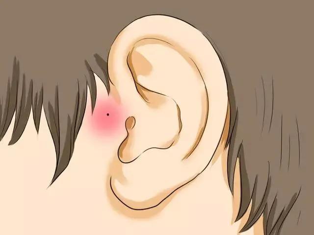 耳前瘘管手术宝宝,7个月宝宝有耳前瘘管可以手术吗