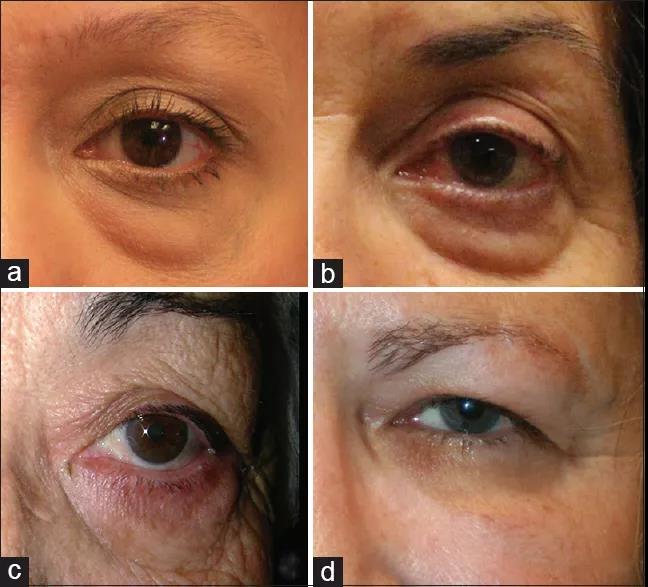 拯救黑眼圈最全宝典,该怎样拯救我的黑眼圈