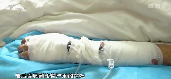 好可怕！老师傅手臂肿成这样险些截肢，只是因为被树皮扎了个小口子