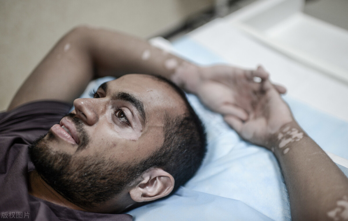 白癜风顽固难治该怎么办才好,稳定了十几年的白癜风需要治疗吗