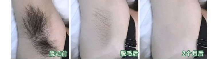 j-style冰点脱毛仪,j-style光子嫩肤脱毛仪