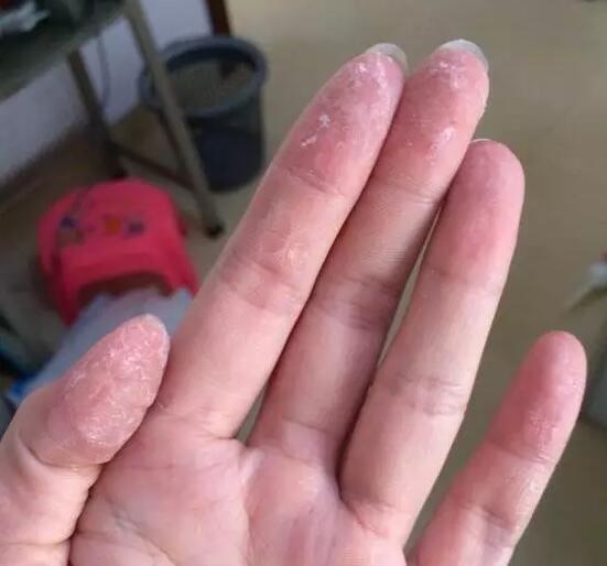 502胶水把手粘住了怎么办,502胶水把手粘住了怎么解决