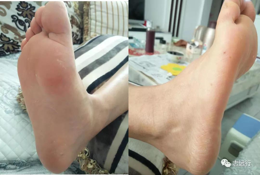 张景明治疗手足癣的中药方,手足癣单方大全