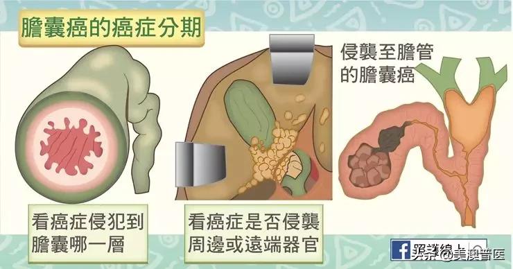 胆结石不治疗多久会转变为癌,胆结石不治疗会越来越严重吗