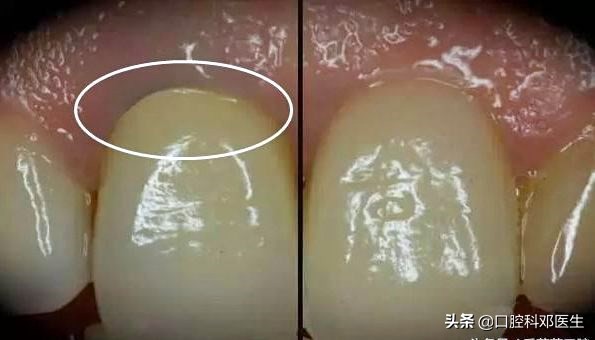 牙医为啥都推荐种植牙,为什么医生总是推荐做全瓷牙