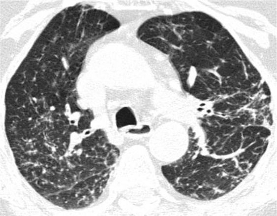 间质性肺疾病看病经验分享,分享肺腺癌临床实验的例子